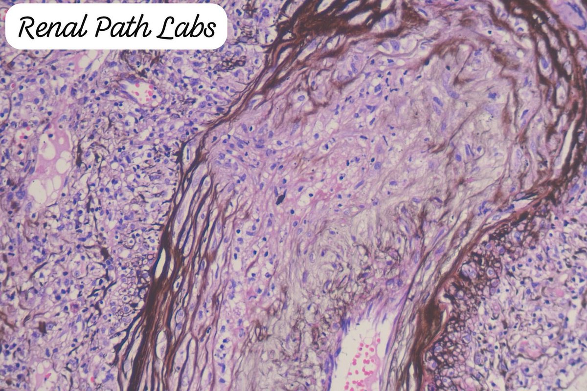 RenalPathLabs's tweet image. Images say it all. The disease,the process,possible culprit, the misery of that organ system & about the nicely done stain..Residents,want to describe this pic?Native Bx
#PathoResidents #NephrologyResidents #PathTwitter #Nephtwitter #AskRenal #RenalPathLabsGurugram @Renalpathsoc
