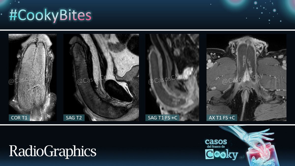Hombre de 46 años con erección prolongada y dolorosa. ¿Cuál es el diagnóstico?
Publicaremos la respuesta en 24 horas. Comparte casos similares con nosotros usando #CasosCooky #CookyBites #168. ¡Haremos RT a los mejores casos!
#RGphx <a href="/cookyscan1/">Cooky Menias</a> <a href="/RadioGraphics/">RadioGraphics</a>