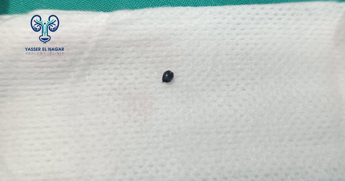 🎗️ penile foreign body  (Reich) in mine worker.
🎗️ Despite being very small ,the thermal effect lead to significant fibrosis in corporal wall and in penile skin.
🎗️Lucky patient  as the reich stay superficial.