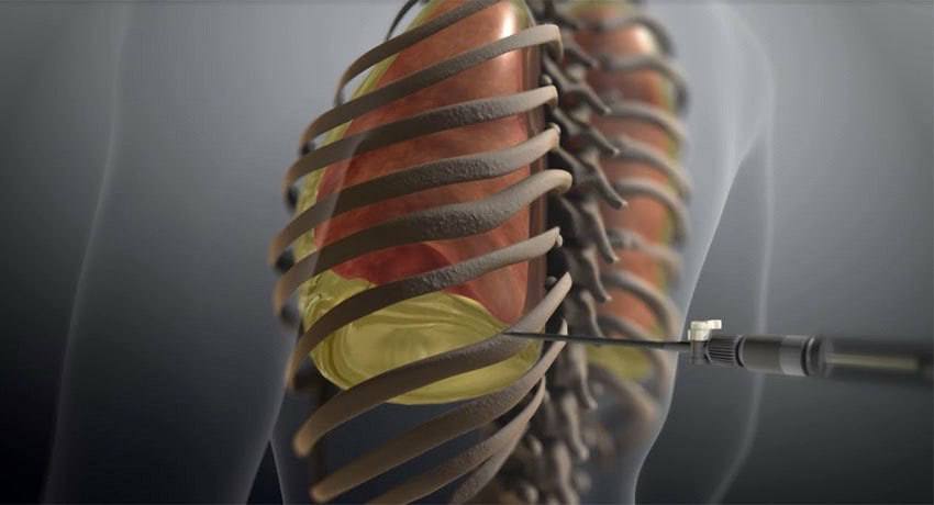 Smart1Doctor1's tweet image. Thoracocentesis.

A procedure involving inserting a special needle between the ribs to remove fluid or air from the pleural cavity in cases of pneumo/hemo/pyothorax..
.
.
.
.
#Thoracocentesis #PleuralCavity #MedicalProcedure #Pneumothorax #Hemothorax #Pyothorax #RespiratoryHealth…