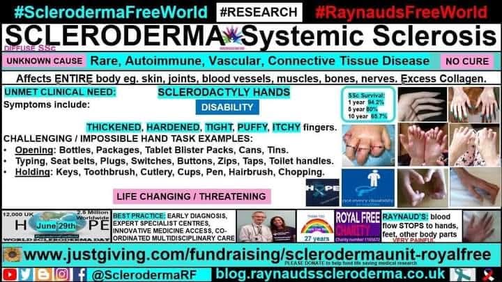 cosmicfairy444's tweet image. June #SclerodermaAwarenessMonth sclerodactyly hands and the subsequent #disability. Stiff, fragile fingers covered by tight skin
blog.raynaudsscleroderma.co.uk/2018/05/sclero…
#SclerodermaFreeWorld #RaynaudsFreeWorld #Research #Scleroderma #SystemicSclerosis #Raynauds #Autoimmune #RareDisease #NoCure