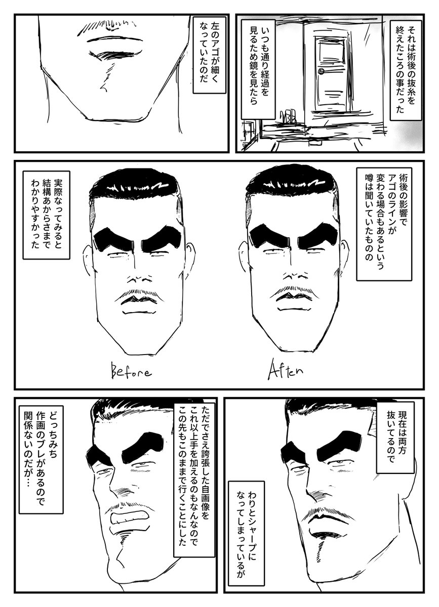 親知らず抜歯漫画下顎編 後編 
前編はURLから 続きはリプ欄から
https://t.co/yo45GQH3nG 