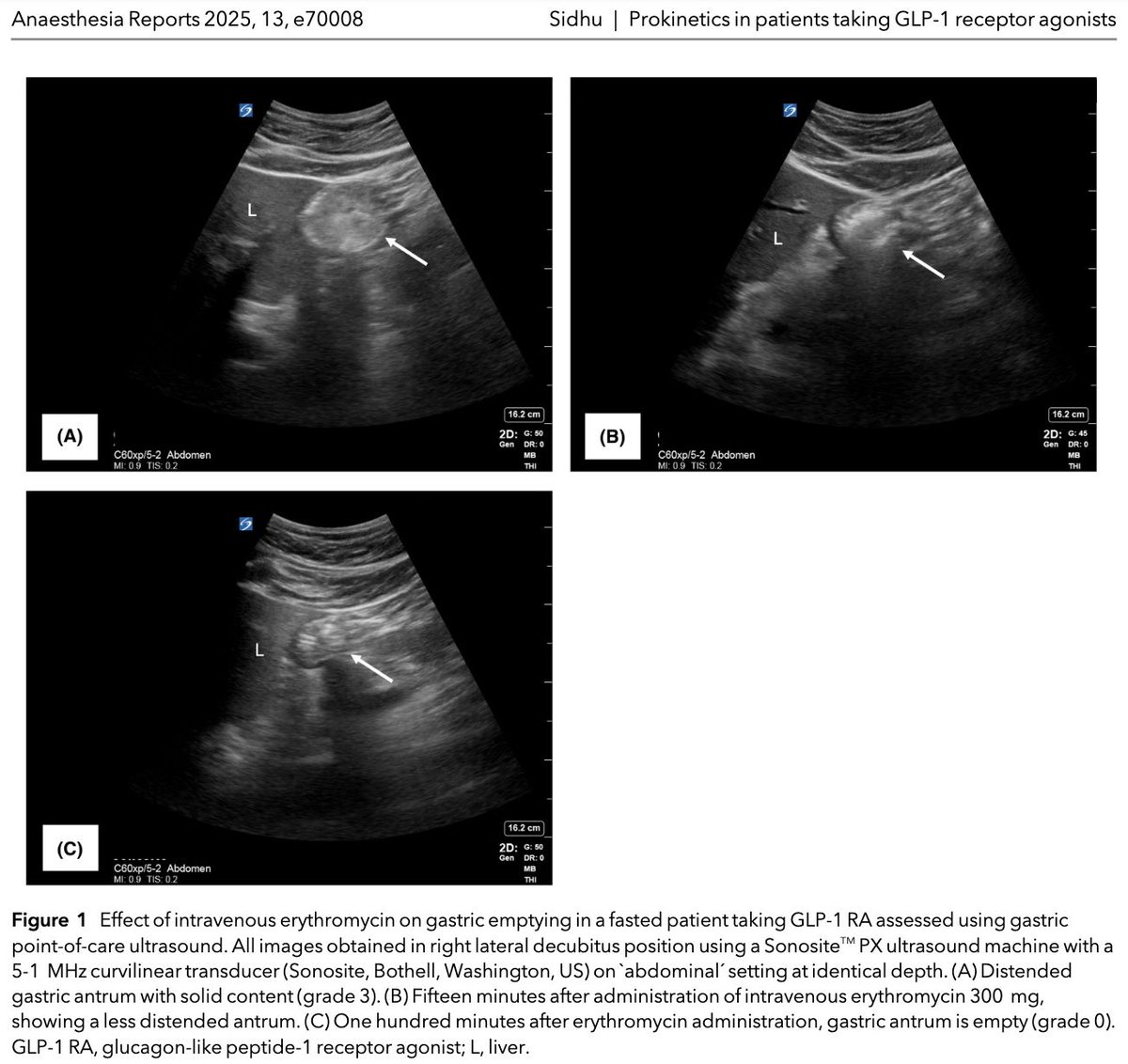 Interested in the effect of intravenous erythromycin on gastric emptying in a fasted patient taking a GLP-1 RA?

Check out these gastric point-of-care ultrasound pictures!

#anaesthesia @drnavsidhu

doi.org/10.1002/anr3.7…