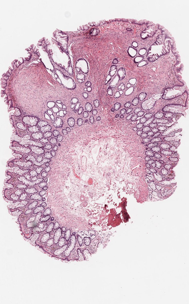 DrCycloPath's tweet photo. A sessile polyp is found in the sigmoid colon. 

What is the diagnosis?

A) Leiomyoma
B) Schwannoma
C) GIST
D) Perineurioma

#PathTwitter #Pathology #GIPath

WSI: https://t.co/Nwzc7j3ctJ https://t.co/jFYCCsmnFl