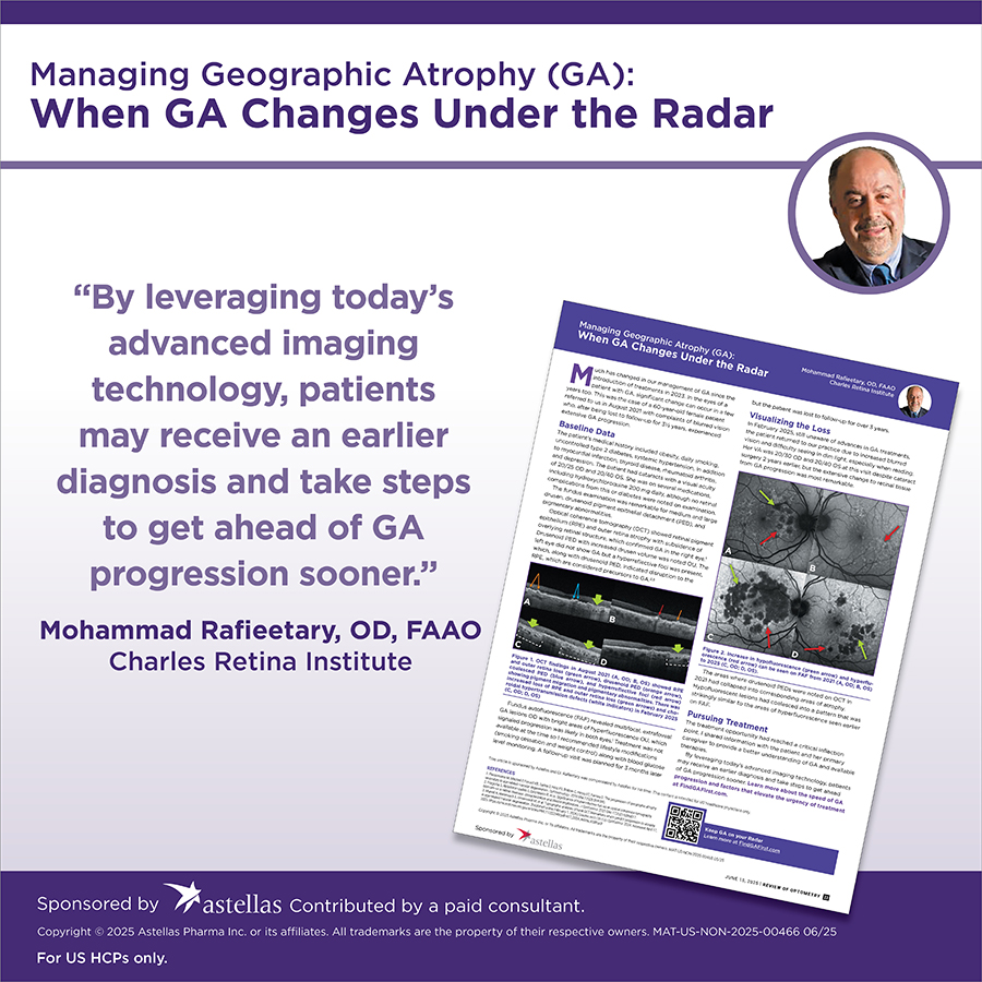 #sponsored Mohammad Rafieetary, OD, shows how extensively #geographicatrophy can progress in a patient returning 3yrs after initial Dx with vision complaints. Look at the GA imaging biomarkers at baseline &amp; subsequent loss of retinal tissue in this case: qgdigitalpublishing.com/publication/?i…