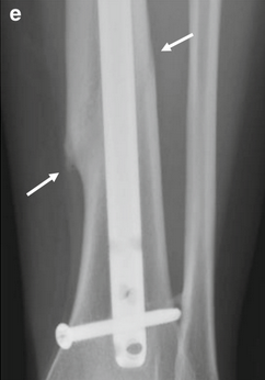 Dr. Basti (@drbastimd) on Twitter photo 🤖¿Sabías que no hay un consenso claro sobre cómo evaluar si una fractura ha consolidado? Hoy revisamos el artículo "Evaluación Radiológica de la Consolidación de Fracturas" publicado en Skeletal Radiology.🧵¡Sigue este hilo para saber más del tema! 🤖¿Sabías que no hay un consenso claro sobre cómo evaluar si una fractura ha consolidado? Hoy revisamos el artículo "Evaluación Radiológica de la Consolidación de Fracturas" publicado en Skeletal Radiology.🧵¡Sigue este hilo para saber más del tema!
