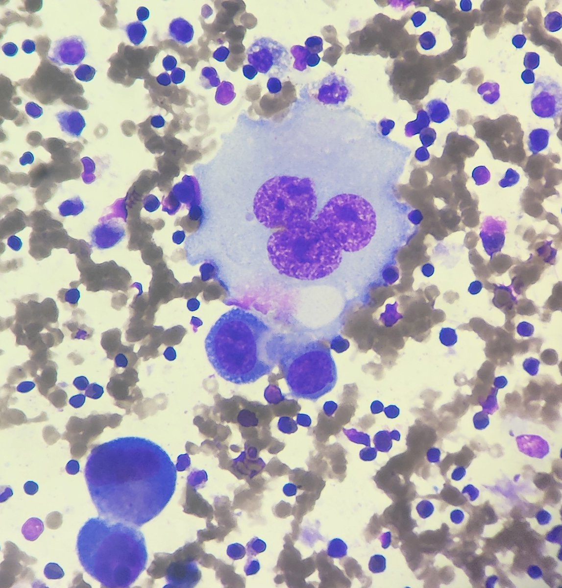 padmapathology1's tweet photo. Mickey mouse nucleus
#cytopath #PathTwitter
#SmallLittleThings https://t.co/5YDpkFDx0k