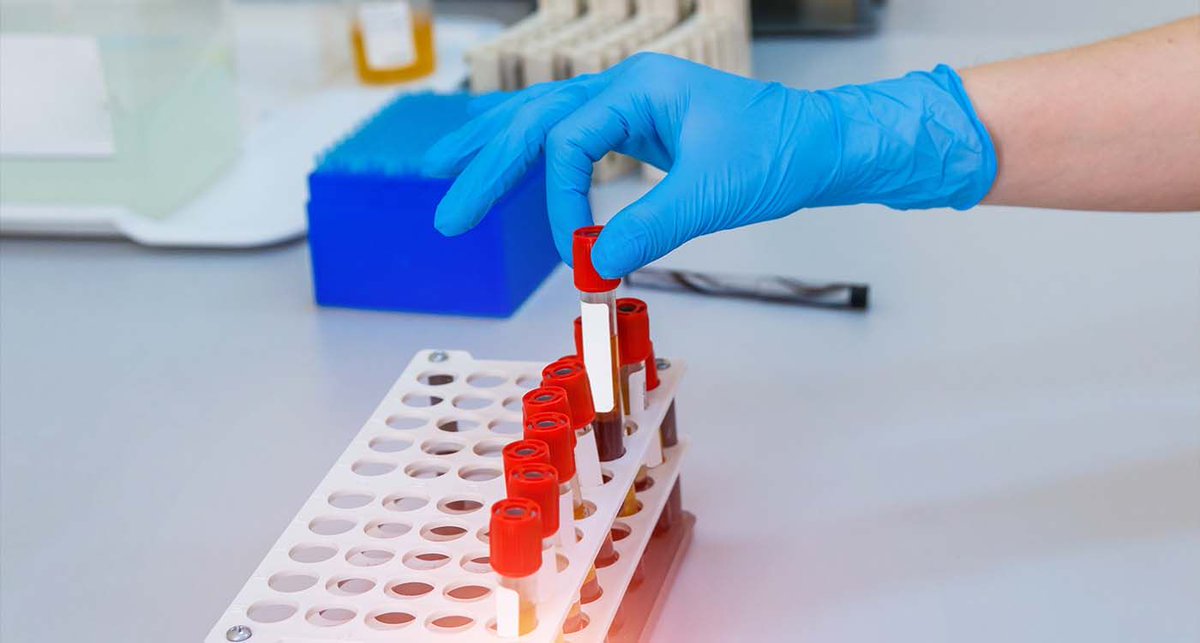 #SCIENCE  

Une Française d’origine guadeloupéenne a été identifiée comme la seule porteuse d’un groupe sanguin totalement inconnu: « Gwada négatif ». Une découverte scientifique majeure, et un défi urgent pour la médecine transfusionnelle.

Par Bélinda Ibrahim
<a href="/belibrahim/">Bélinda Ibrahim</a>