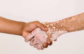 25 de junio-Día Mundial del Vitiligo 🤍
Una jornada para visibilizar, informar y acompañar.
El vitiligo no duele, pero muchas veces marca más en lo emocional que en la piel.
La empatía, el conocimiento y el respeto también son parte del tratamiento.