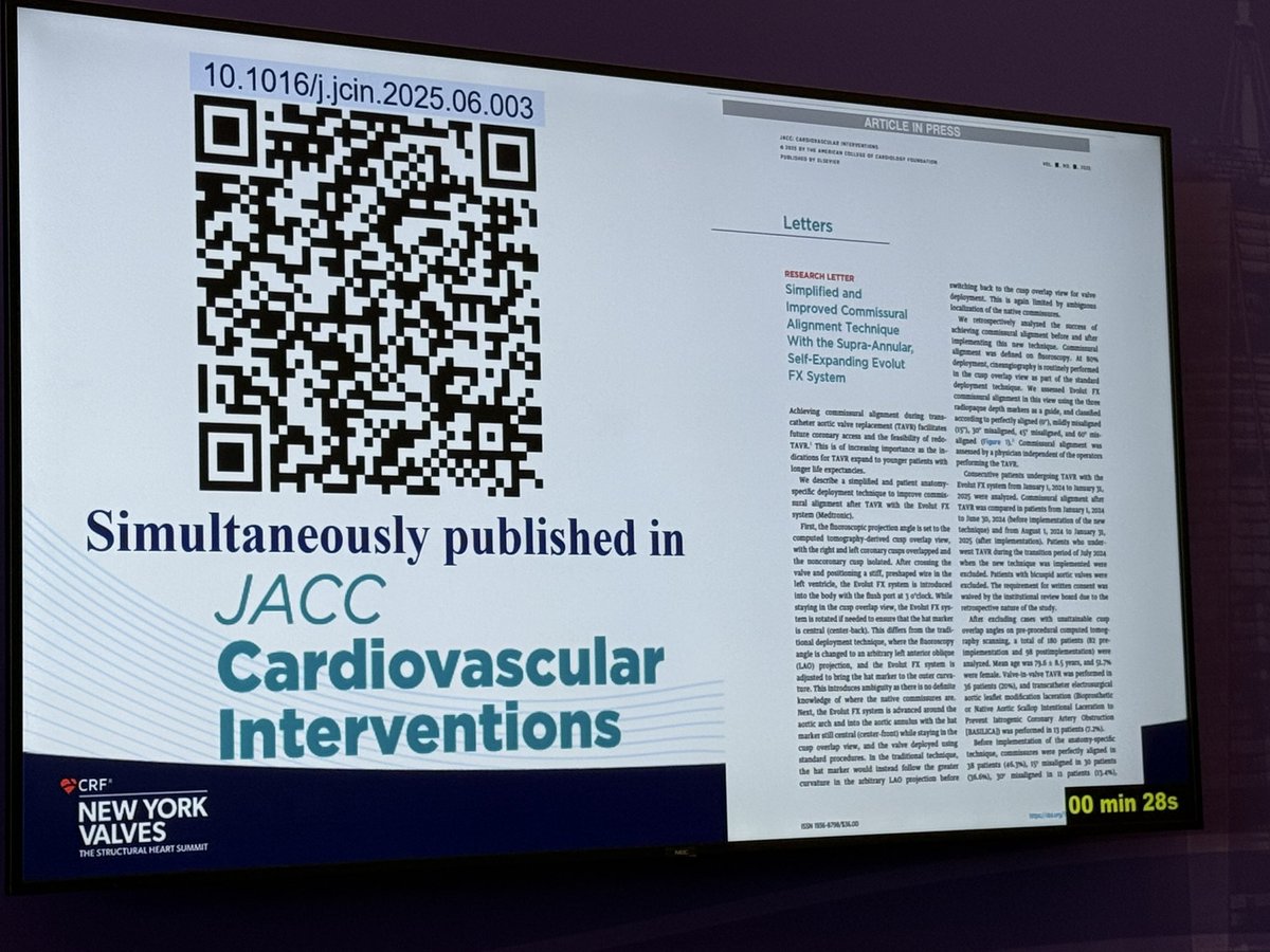 Jaffar Khan (@cathelectrosurg) on Twitter photo Kicking off #NYValves2025 with <a href="/StFrancis_LI/">St. Francis Hospital & Heart Center</a> super fellow Chris Koo presenting our anatomy specific cusp overlap technique.
Simultaneously published in <a href="/JACCJournals/">JACC Journals</a> and to be adopted by <a href="/Medtronic/">Medtronic</a> <a href="/KendraGrubb/">Kendra J. Grubb M.D.</a> as new standard. Kicking off #NYValves2025 with <a href="/StFrancis_LI/">St. Francis Hospital & Heart Center</a> super fellow Chris Koo presenting our anatomy specific cusp overlap technique.
Simultaneously published in <a href="/JACCJournals/">JACC Journals</a> and to be adopted by <a href="/Medtronic/">Medtronic</a> <a href="/KendraGrubb/">Kendra J. Grubb M.D.</a> as new standard.