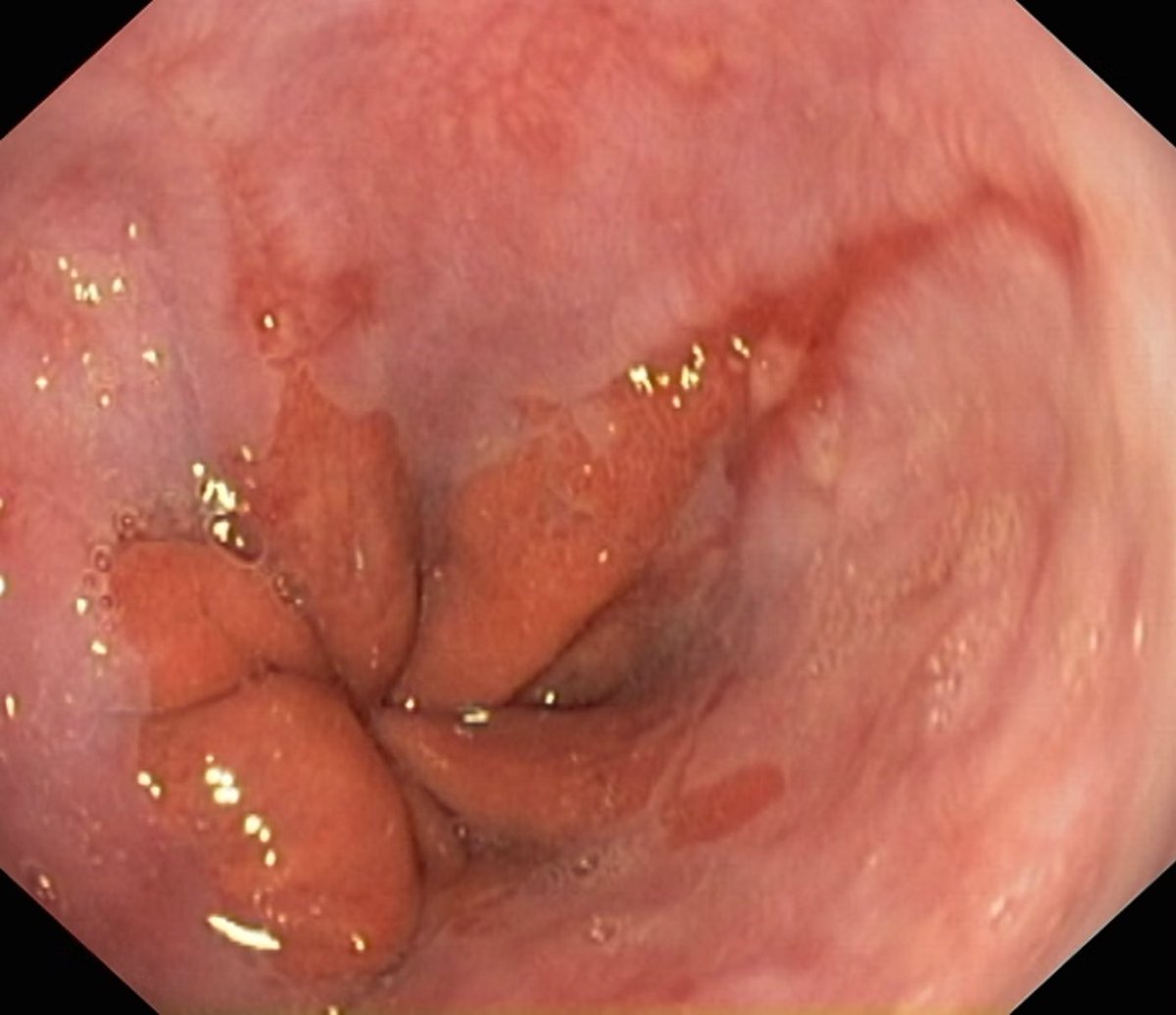New Twitter Quiz

Based on the Los Angeles Classification, what grade of erosive esophagitis is this?

A
B
C
D

Reply below with your answer and I will DM you (must be following so I can DM you) the correct classification with a great Los Angeles Classification chart.