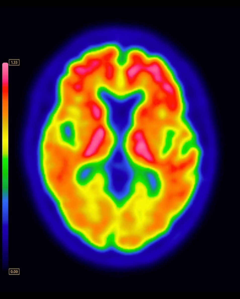 Diagnostic Imaging (@dx_imaging) on Twitter photo FDA Approves Multiple New Indications for the Brain PET Imaging Agent Vizamyl
diagnosticimaging.com/view/fda-multi…
<a href="/RadiologyACR/">American College of Radiology</a> <a href="/ARRS_Radiology/">ARRS</a> <a href="/RSNA/">RSNA</a> <a href="/SNM_MI/">SNMMI</a> <a href="/TheASNR/">The American Society of Neuroradiology</a> <a href="/NeuroSinai/">Mount Sinai Neuroradiology</a> <a href="/EmoryNeurorads/">Emory Neuroradiology</a> <a href="/DukeNeurorad/">DukeNeuroradiology</a> <a href="/PennRadiology/">Penn Radiology</a> <a href="/Hopkins_Rad/">Johns Hopkins Radiology</a> <a href="/OSURadiology/">Ohio State Radiology</a> <a href="/GEHealthCare/">GE HealthCare</a>
#radiology #RadRes FDA Approves Multiple New Indications for the Brain PET Imaging Agent Vizamyl
diagnosticimaging.com/view/fda-multi…
<a href="/RadiologyACR/">American College of Radiology</a> <a href="/ARRS_Radiology/">ARRS</a> <a href="/RSNA/">RSNA</a> <a href="/SNM_MI/">SNMMI</a> <a href="/TheASNR/">The American Society of Neuroradiology</a> <a href="/NeuroSinai/">Mount Sinai Neuroradiology</a> <a href="/EmoryNeurorads/">Emory Neuroradiology</a> <a href="/DukeNeurorad/">DukeNeuroradiology</a> <a href="/PennRadiology/">Penn Radiology</a> <a href="/Hopkins_Rad/">Johns Hopkins Radiology</a> <a href="/OSURadiology/">Ohio State Radiology</a> <a href="/GEHealthCare/">GE HealthCare</a>
#radiology #RadRes