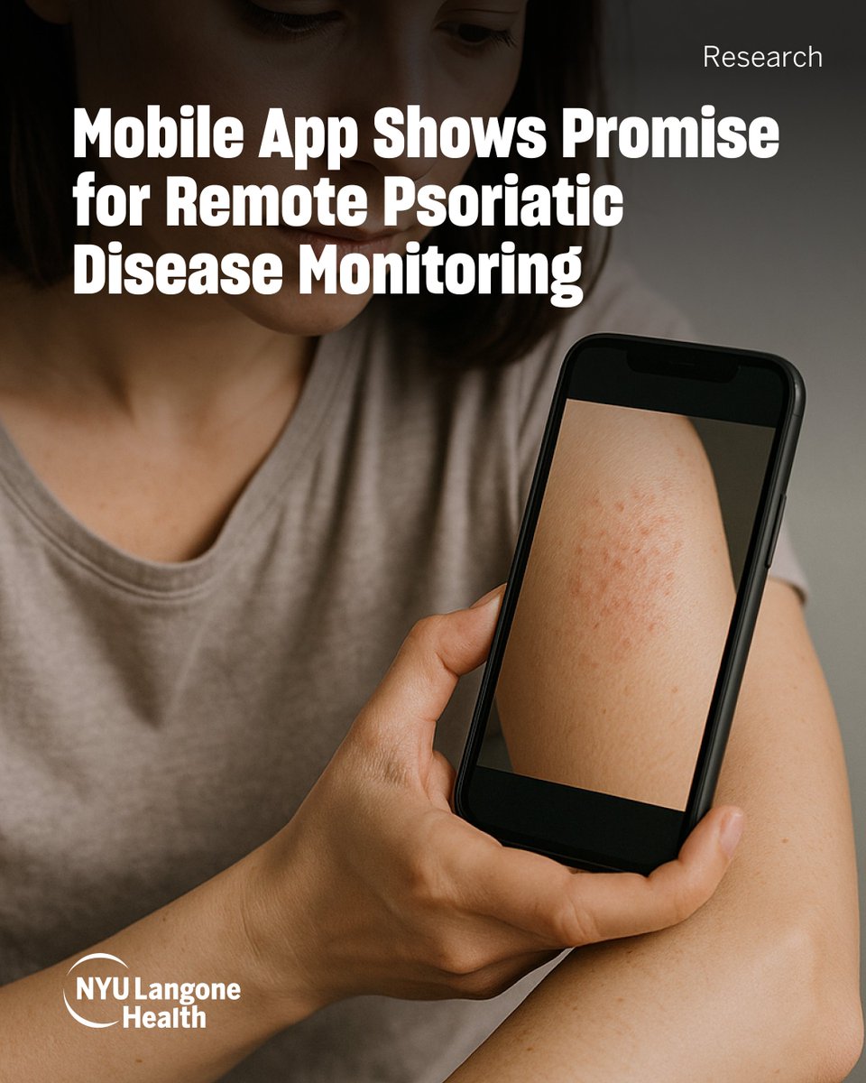 nyugrossman's tweet image. Can a smartphone app detect psoriatic arthritis flare? NYU Langone researchers found Psorcast app can capture skin and joint symptoms with clinical accuracy, without an office visit.
📲 Read the study: bit.ly/4emgkpM
#PsoriaticDisease #HealthTech