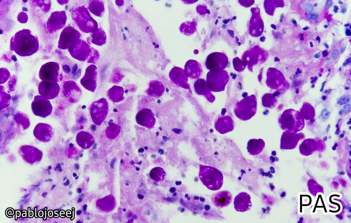 🦠 Entamoeba histolytica (Amebiasis).
 &gt; Trophozoites with erythrophagocytosis 
&gt; PAS positive.

#Pathology #AnatomíaPatológica 
#PathArt