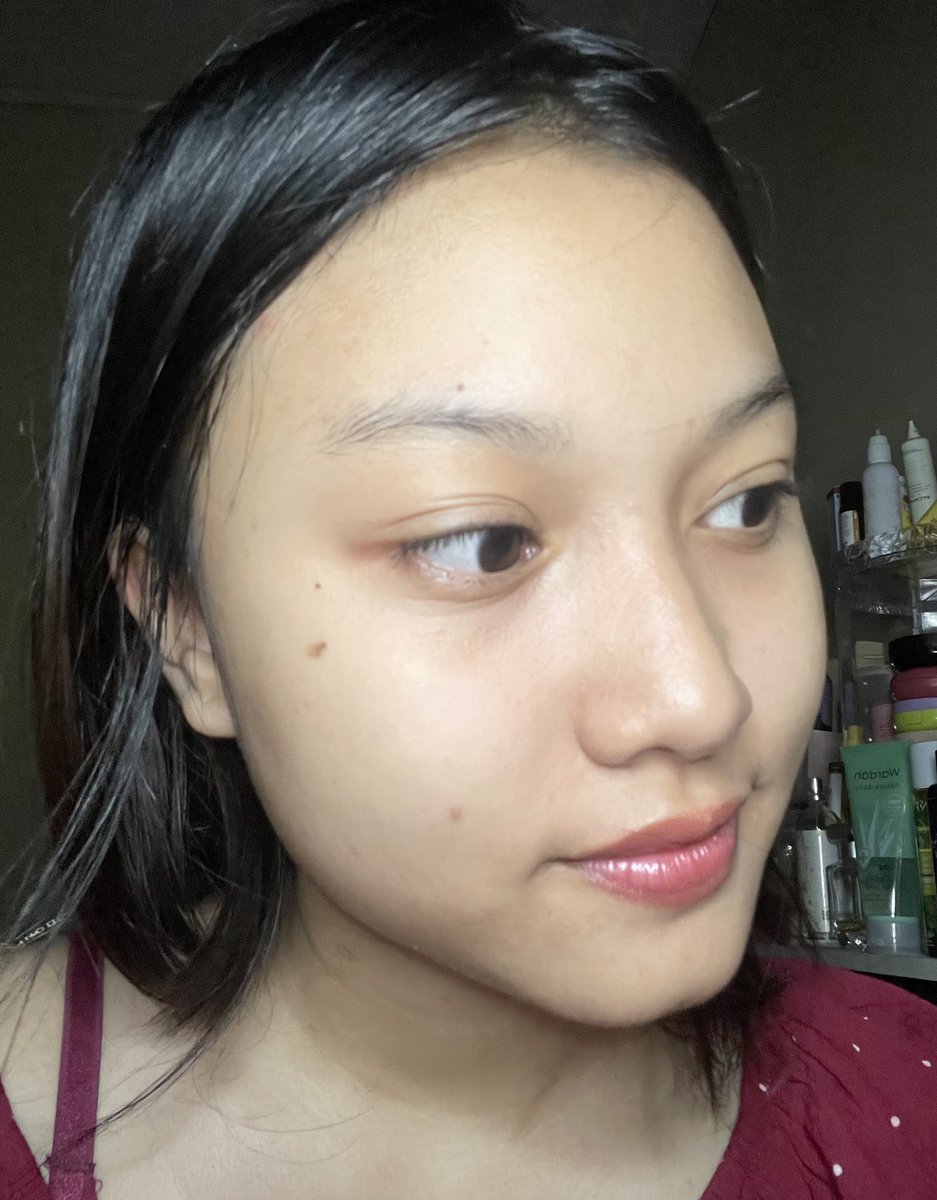 shaarizenw's tweet photo. udah ga pernah panik lagi kalau ada jerawat, karena sekarang sembuhin jerawat bisa INSTAN.. 😩

rahasianya: pake face sanitizer! bonus bikin kulit lebih bersih 🍂 https://t.co/Ic2G9PjjBK
