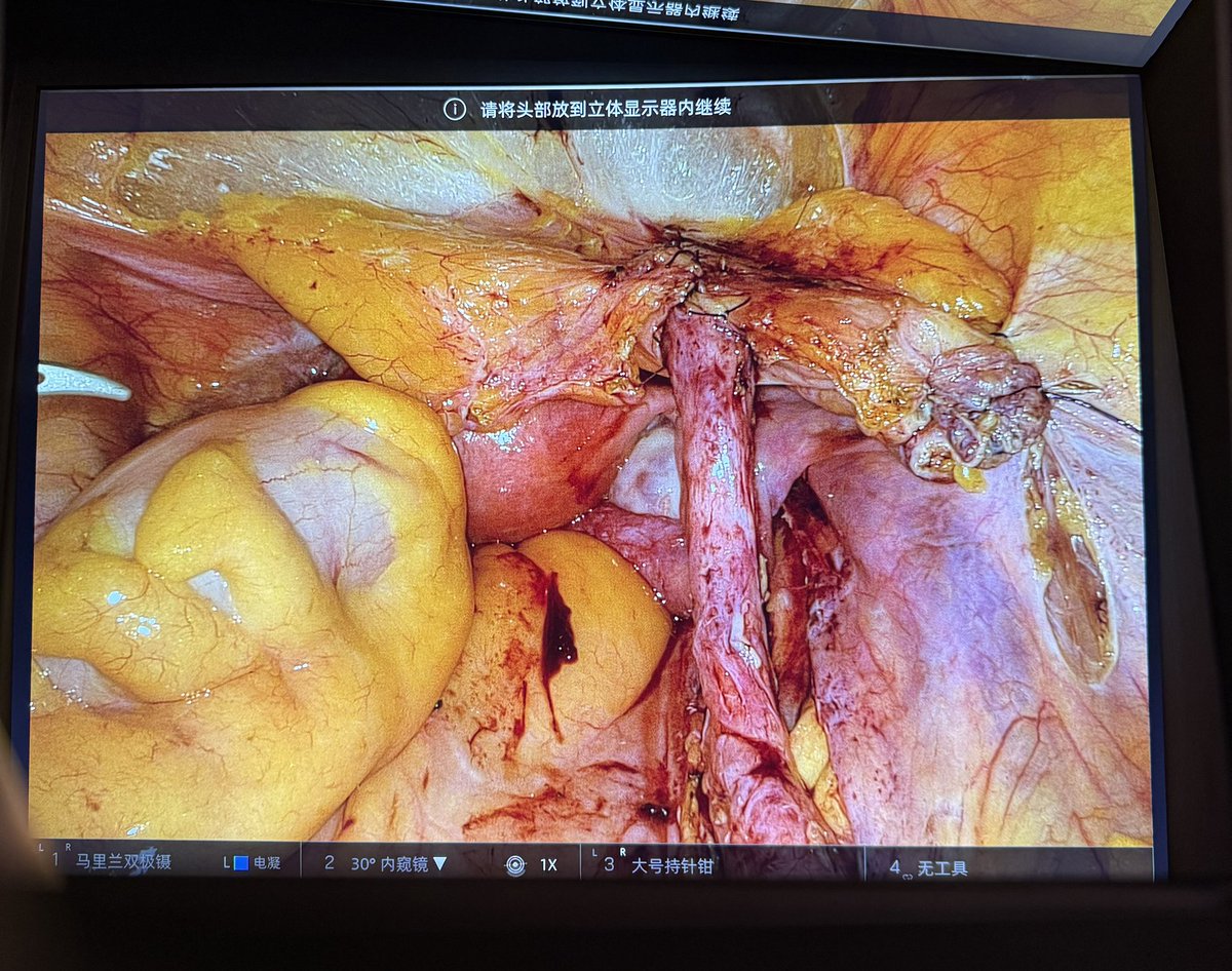 Ureteral reimplantation for ureteral endometriosis