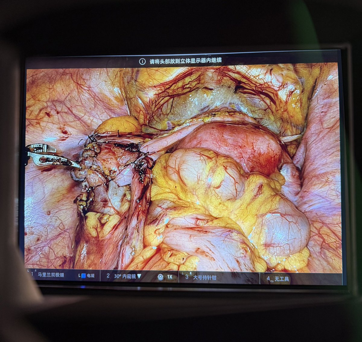 Ureteral reimplantation for deep endometriosis disease