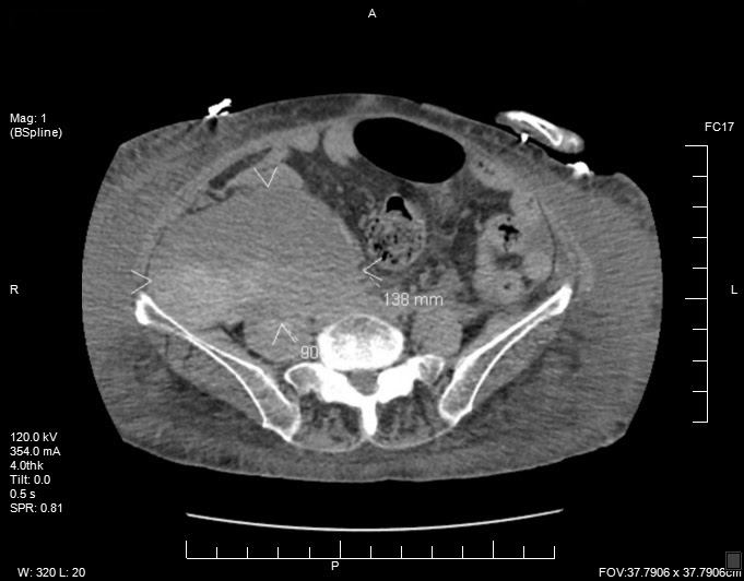InvasiveCardiol's tweet image. #AFib Topic Center: Spontaneous Psoas Hematoma Secondary to Anticoagulation
The authors present a case of a woman who developed spontaneous retroperitoneal hematoma secondary to anticoagulation.
hubs.ly/Q03rWPzk0 #cardioTwitter #cardioX #cardiology #interventionalcardiology