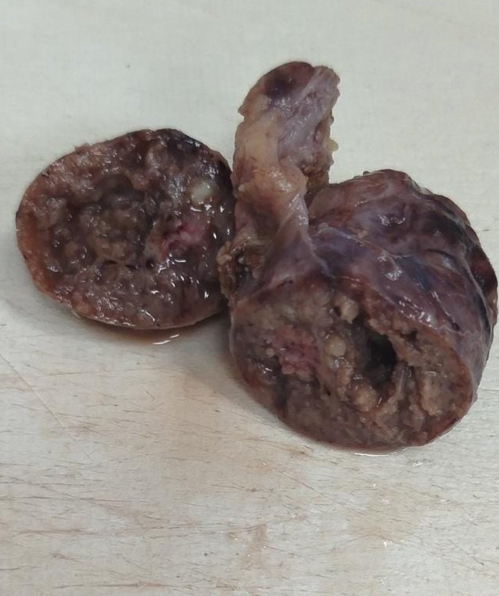 Beautiful Warthin tumour 😎🙏 (Papillary cystadenoma lymphomatosum 🤦‍♂️😁) 
#pathology #gross #PathTwitter