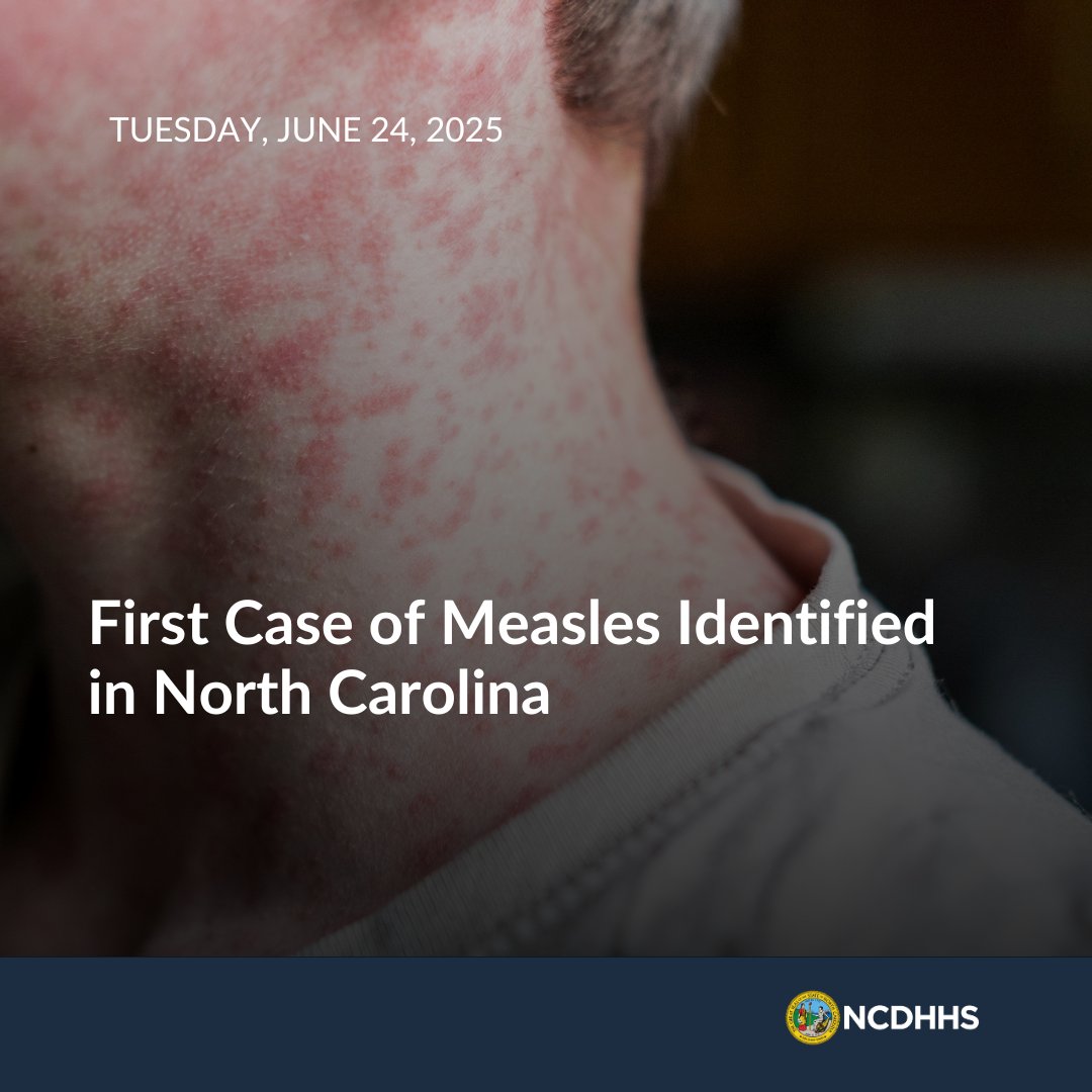 NCDHHS has confirmed a case of measles in a child who was visiting Forsyth and Guilford counties. The child became ill while traveling to NC from another country where measles outbreaks have recently been reported. To protect the individual and their family’s privacy, no