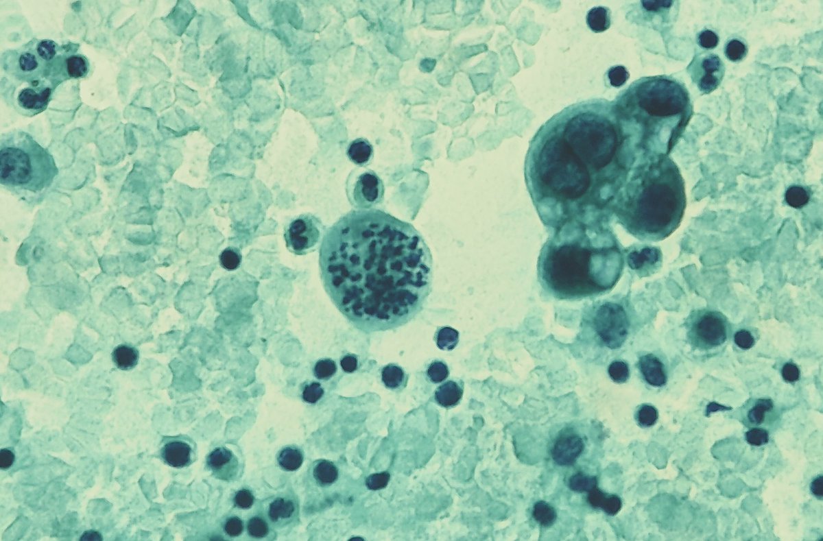 #aneuploidy
#polyploidy
#TooManyToCount
#PathTwitter 
#cytopath
#SignsOfMalignancy