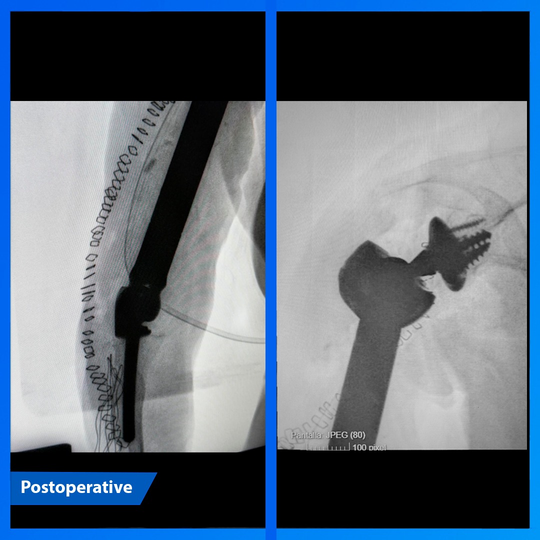 medcomtech_sa's tweet photo. Dr. I. Silva en el H. Doctor Negrín, junto con el Dr. Isidro de Gracias, operaron a una paciente de 78 años con pseudoartrosis humeral, defecto óseo masivo y fallo de osteosíntesis previas. Se realizó reemplazo total de húmero con implante tumoral ProSpon distr. por #medcomtech https://t.co/yMdHVYBYPV