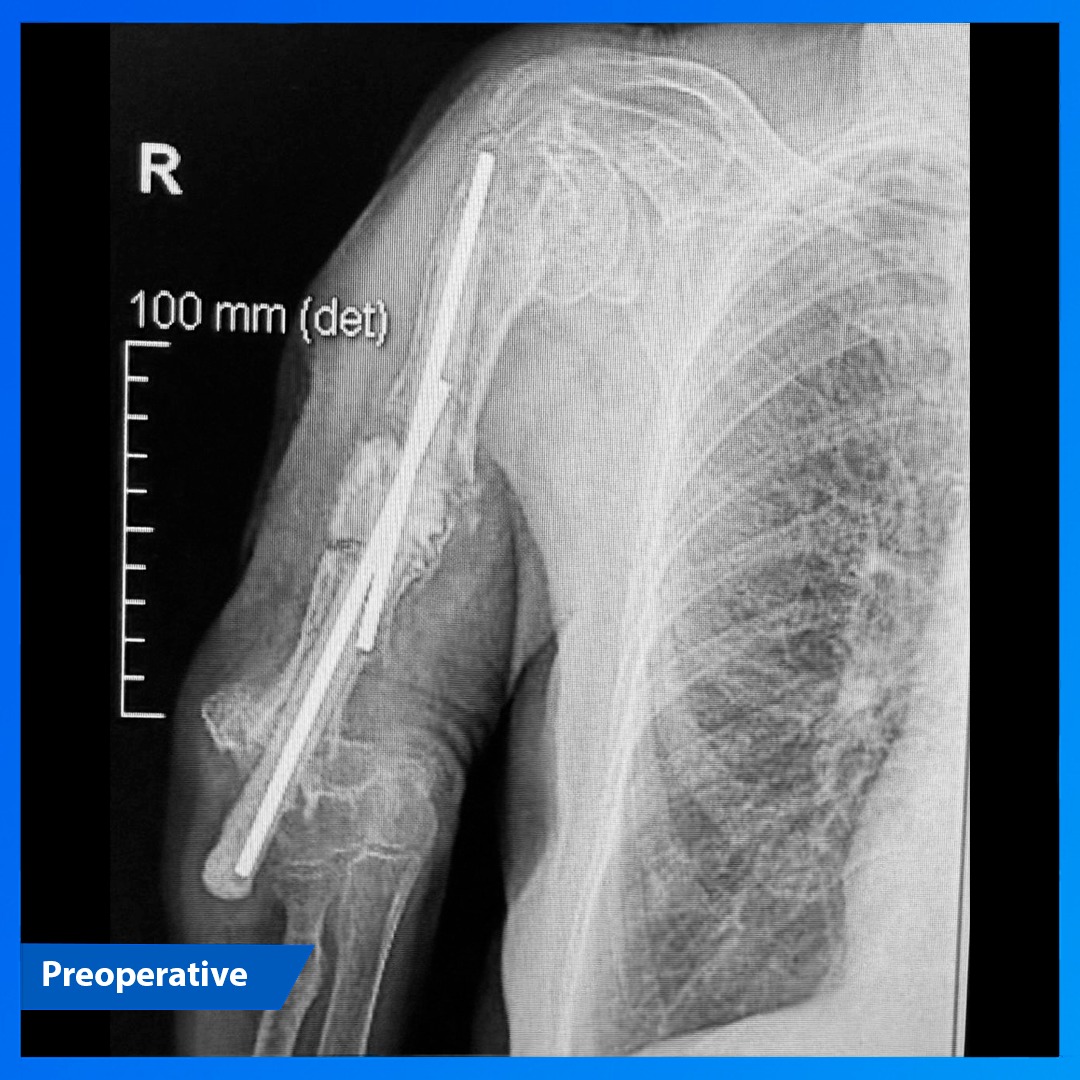 medcomtech_sa's tweet photo. Dr. I. Silva en el H. Doctor Negrín, junto con el Dr. Isidro de Gracias, operaron a una paciente de 78 años con pseudoartrosis humeral, defecto óseo masivo y fallo de osteosíntesis previas. Se realizó reemplazo total de húmero con implante tumoral ProSpon distr. por #medcomtech https://t.co/yMdHVYBYPV