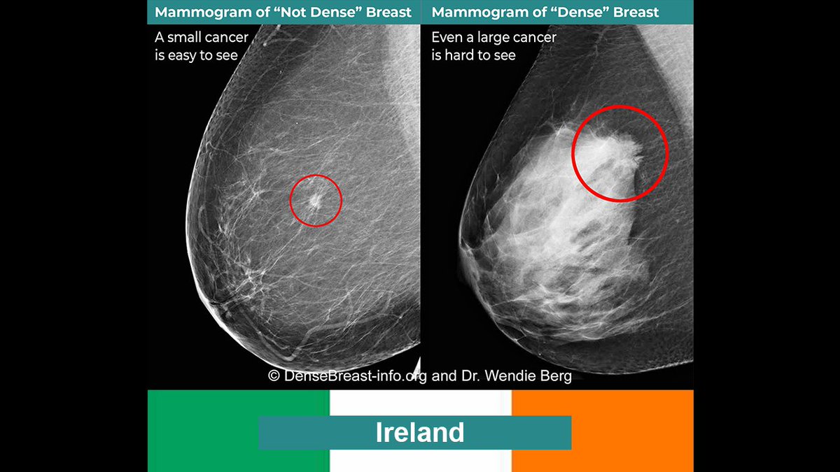 DenseBreast-Info.org (@densebreastinfo) on Twitter photo Visits from Ireland to densebreast-info.org surged in May as “Inform” advocacy grows and talks of standardized density notification continue. 🇮🇪
Awareness is rising—thank you!
@HSE_Live <a href="/NSShse/">National Screening Service</a> <a href="/IrishCancerSoc/">Irish Cancer Society</a> <a href="/Cheryl_Cruwys/">BreastDensityMatters</a>
#DenseBreasts #Ireland #KnowYourDensity Visits from Ireland to densebreast-info.org surged in May as “Inform” advocacy grows and talks of standardized density notification continue. 🇮🇪
Awareness is rising—thank you!
@HSE_Live <a href="/NSShse/">National Screening Service</a> <a href="/IrishCancerSoc/">Irish Cancer Society</a> <a href="/Cheryl_Cruwys/">BreastDensityMatters</a>
#DenseBreasts #Ireland #KnowYourDensity