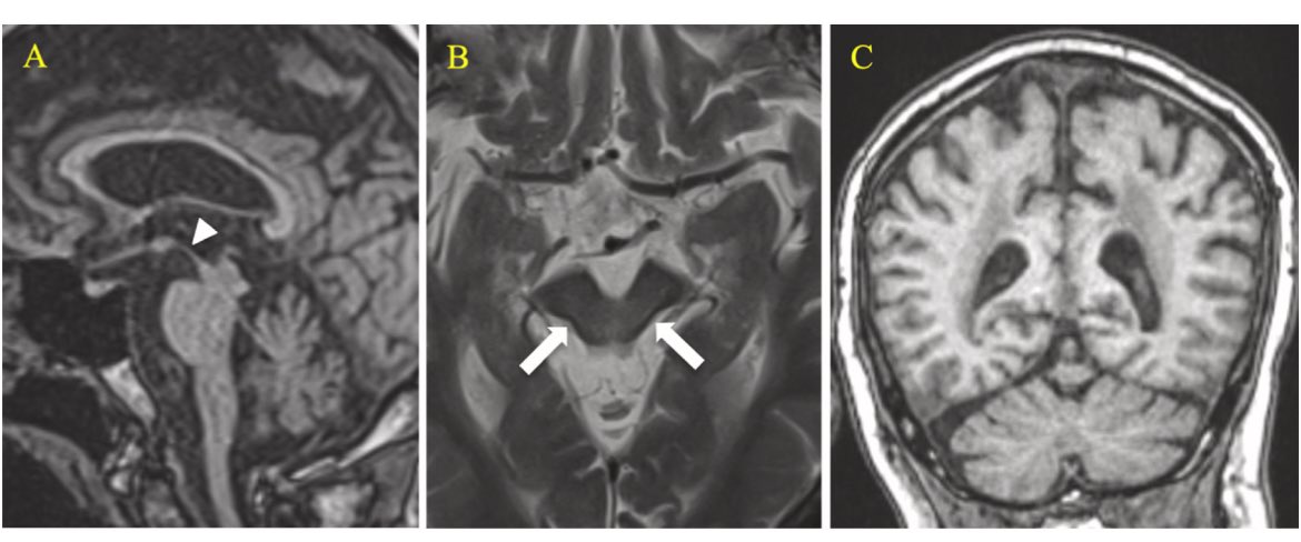 ParkinsonismD's tweet image. A case report of palatal tremor in progressive supranuclear palsy
#palataltremor #PSP #Progressivesupranuclearpalsy
@PRDAssociation
Log in:
prd-journal.com/article/S1353-…
