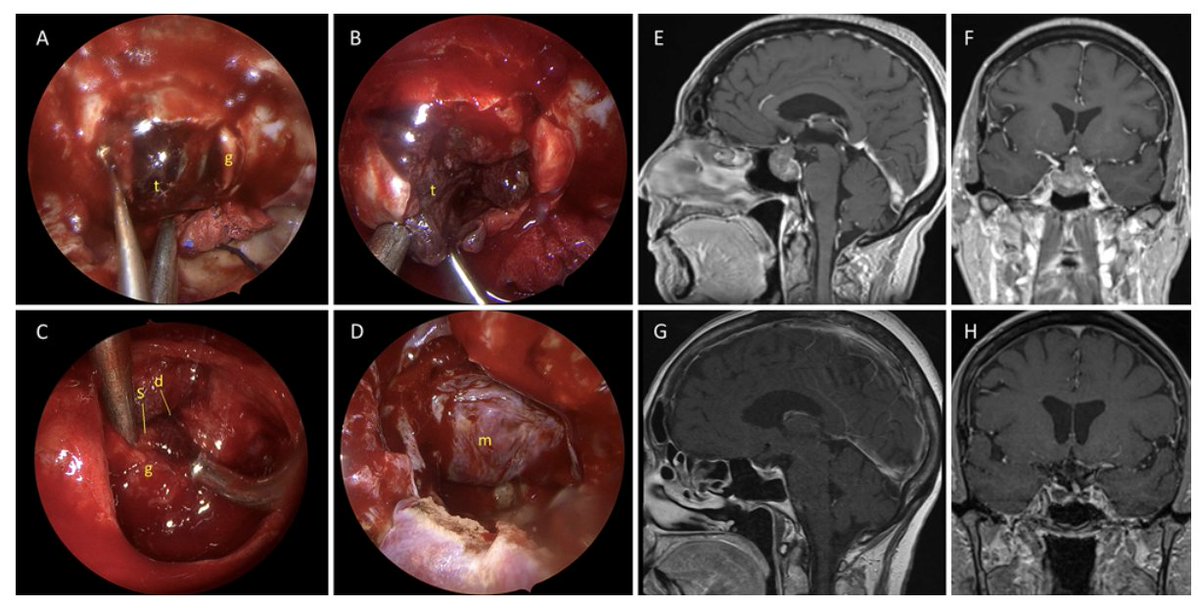 #OnlineFirst: Examining the viability of modern endoscopic endonasal surgery as a first-line treatment for macroprolactinomas.

thejns.org/view/journals/…