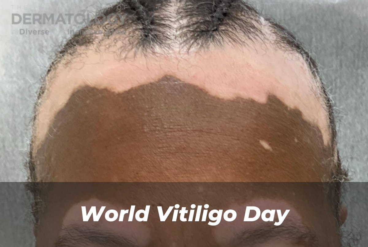 Journal of Drugs in Dermatology (JDD) (@jddonline) on Twitter photo June 25 marks World Vitiligo Day, a global recognition of a condition that affects approximately 0.5-2% of the population worldwide. Where to start, how about here: jddonline.com/project-atlas/… June 25 marks World Vitiligo Day, a global recognition of a condition that affects approximately 0.5-2% of the population worldwide. Where to start, how about here: jddonline.com/project-atlas/…