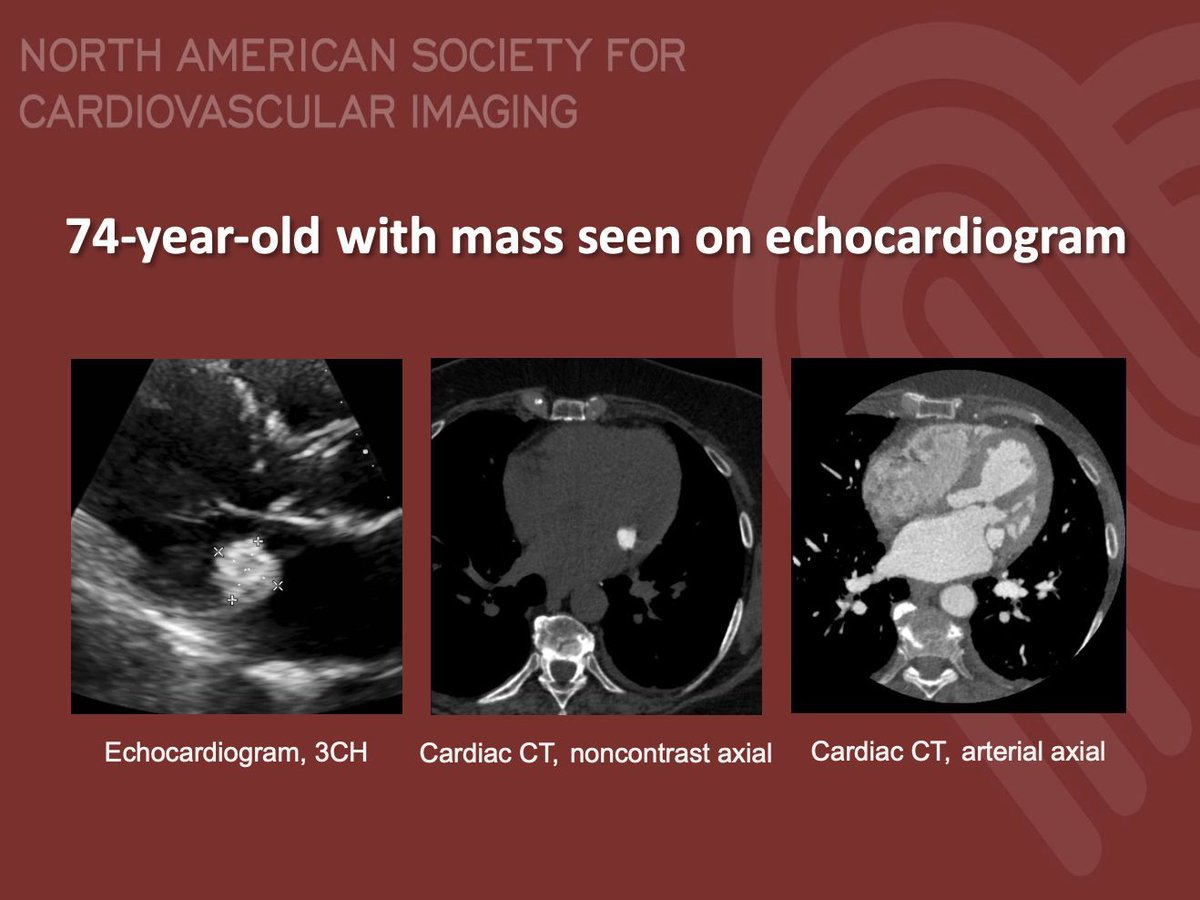 NASCISociety's tweet image. #NASCI Case Series
Case 83
Courtesy of @staziaki from University of Vermont Medical Center
What is the right answer?
#whyCMR #YesCCT
@GregKicska @JRevRad1 @dianalitmano @DanielVargasMD @kirschj @prachipagarwal @AwsHamid5 @EscrOffice @CarlottaOnnis @DeCeccoCN