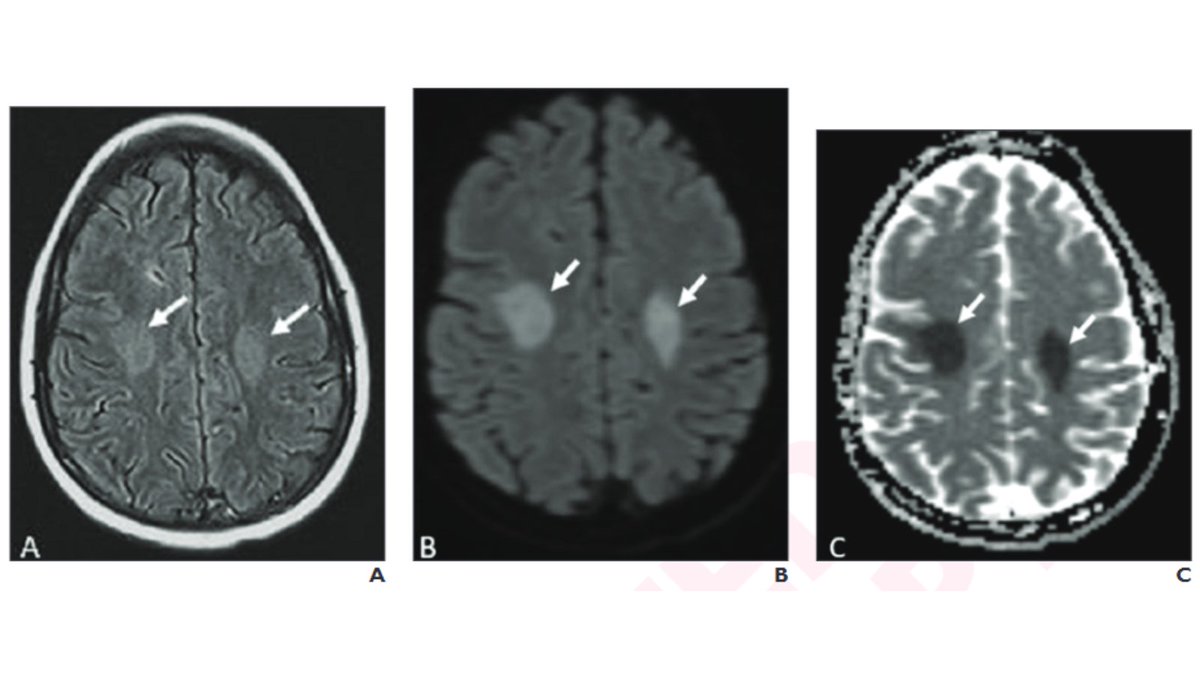 arosenkrantzmd's tweet photo. New @AJR_Radiology Accepted Manuscript:

"Role of Neuroimaging in Cancer-Treatment Neurotoxicity"

By Dr @alvand26 &amp; team @PennRadiology 

https://t.co/Fu75ezLWZ9 https://t.co/xLUIELvKC6