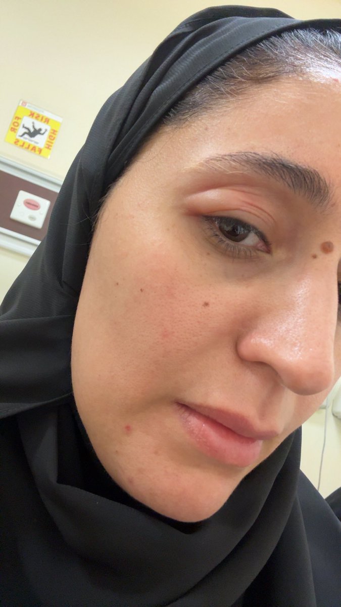 REALTY_2030's tweet image. خبر عاجل 🔺🔺

امس رحت لمحل اسواق خضار وفواكة معروف (واشتريت  من عنده بطيخة) الخضراء الدائرية 

المهم اكلت منها وانا اكل طعمها حلوه بس احس بشي كأنه بودرة معها وانا اكله (الله وكيلكم اخذت وحده كبيره مره حسيت انها مغرية مادريت انها شكلها مليانه كيماويات وسموم) 

بعد ساعه كذا بديت…