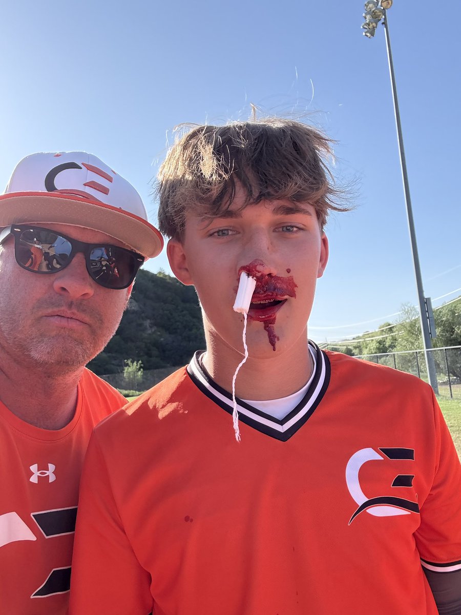 Baseball is fun… Got hit in the face diving back into 1st in Steamboat Springs, CO.