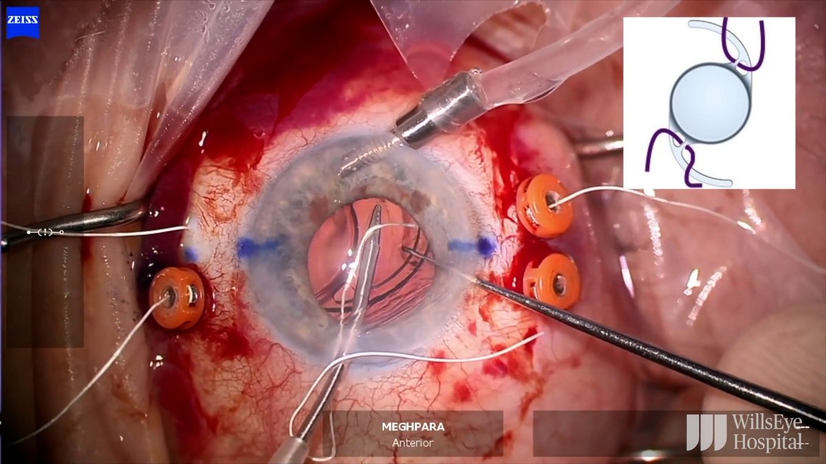 Dr. Beeran Meghpara shares a case in the latest episode of Inside the Wills OR involving a patient with a posterior capsular tear and dislocated IOL. Dr. Meghpara reviews his surgical approach for scleral fixation of an enVista Envy multifocal lens: ow.ly/3SqX50WgnBJ