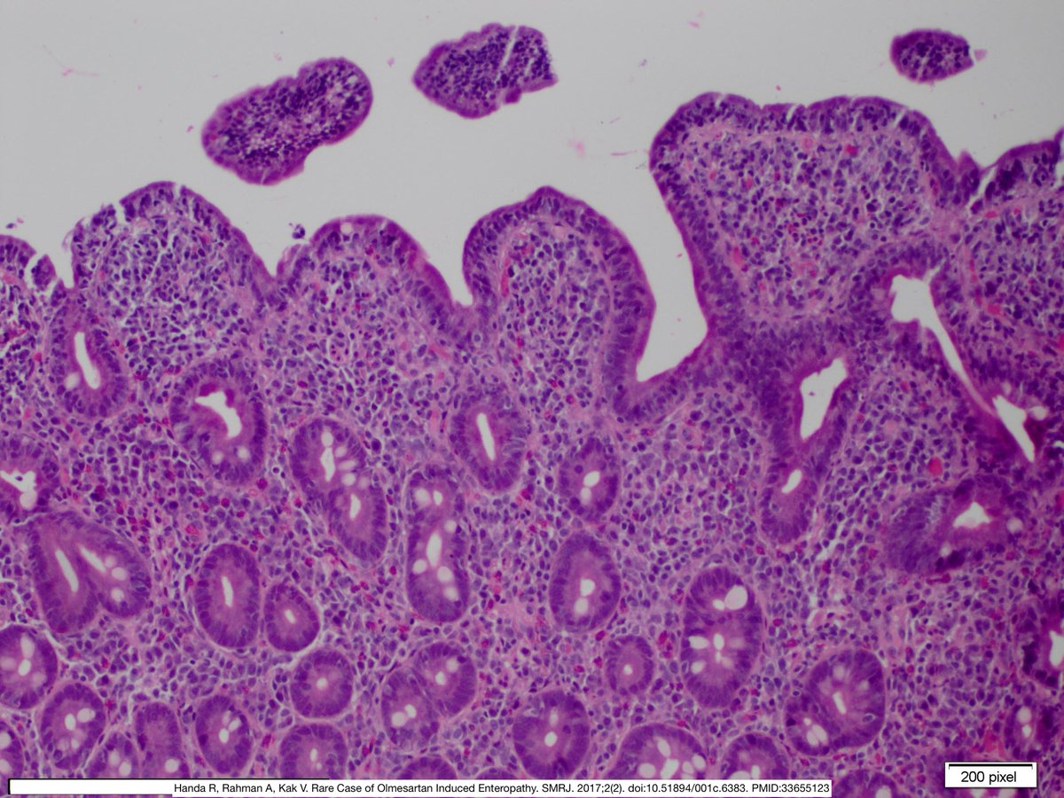 MIMIC of Celiac's Disease +❗️of checking med list esp if nml Celiac🧪:

💊 Olmesartan-induced Enteropathy

Olmesartan 🟰 Angiotensin II receptor blocker to treat HTN

Rare side effect -&gt;enteropathy w prolonged diarrhea+ weight loss
🔬 ➡️  can show IEL+ villous atrophy

#pathx