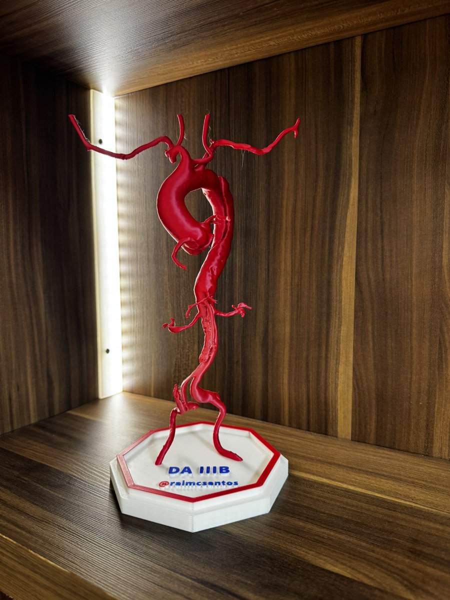 Type B aortic dissection. In this case, below the left subclavian artery to the right external iliac artery. Components of the dissection: 1) Tear 2) Intimal flap 3) Intraluminal thrombus 4) False lumen 5) True lumen. The causes are severe uncontrolled hypertension, drug use