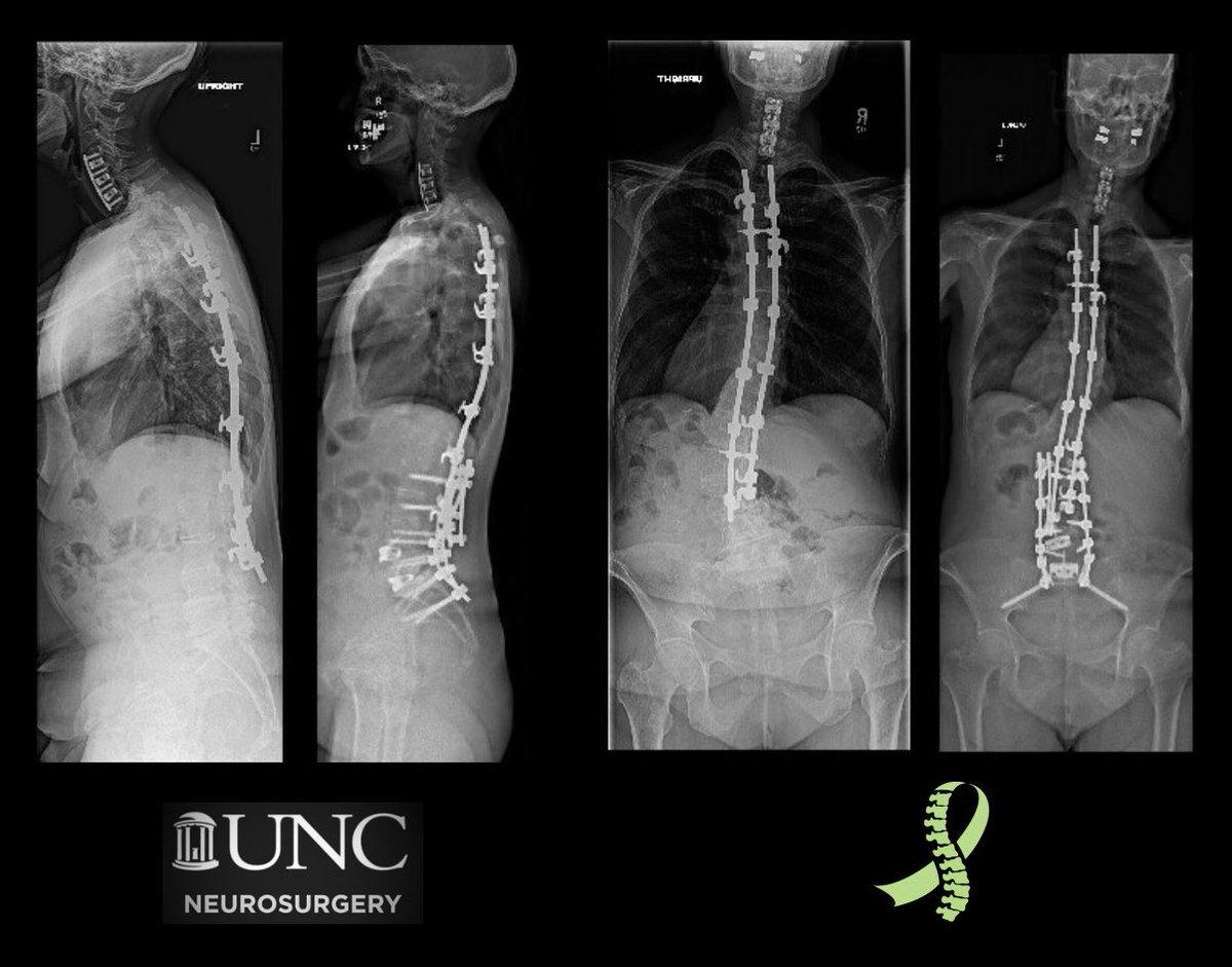 MGalganoMD's tweet image. During #ScoliosisAwareness month, it is worth recognizing all of the OG patients that had some of the earliest iterations of spinal
instrumentation 40-50 years ago.
Many must contend with ASD & sagittal plane offset as they get older.
They are all #scoliosiswarriors!