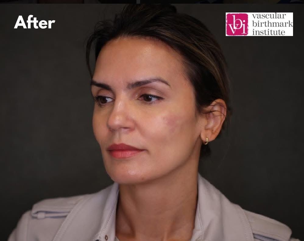 This patient came to us for treatment of a port wine stain on her cheek. After multiple laser sessions, the mark has significantly faded and is now barely visible. We’re incredibly proud of her progress and honored to be part of her journey.

#PortWineStain #VascularBirthmark