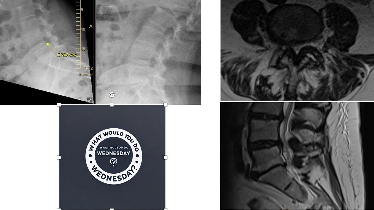 spinesection's tweet image. 🧠 What Would You Do Wednesday? 🧠
👵 75-year-old woman with osteopenia presents with classic claudication symptoms—pain with standing and walking that improves with sitting or leaning forward.
📅 She has undergone conservative therapy including physical therapy, activity…