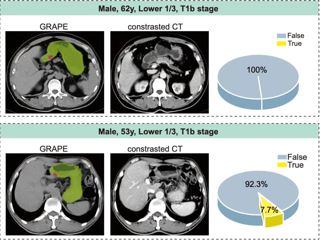 China has unveiled the world's first AI-based model for large-scale gastric cancer (GC) screening, DAMO GRAPE, using noncontrast computed tomography (CT) and deep learning, offering a feasible and effective approach for early detection. 

The model significantly outperformed the