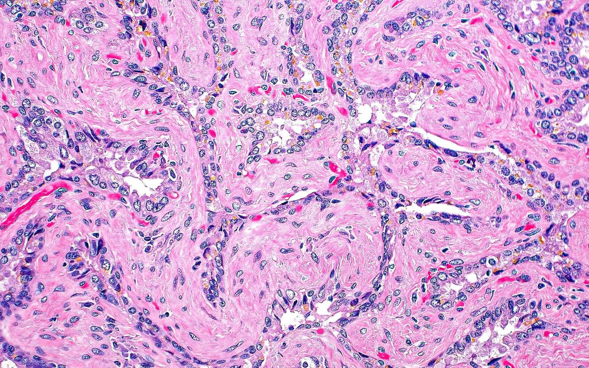 ziad_zaatari's tweet image. 🔬 Seminal Vesicle Epithelium ~ #GUpath #Histology #Pathology #PathArt 📸🎨