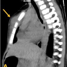 Is this a lesion you should resect or biopsy? Or is it a do not touch lesion?  Source: EuroRad