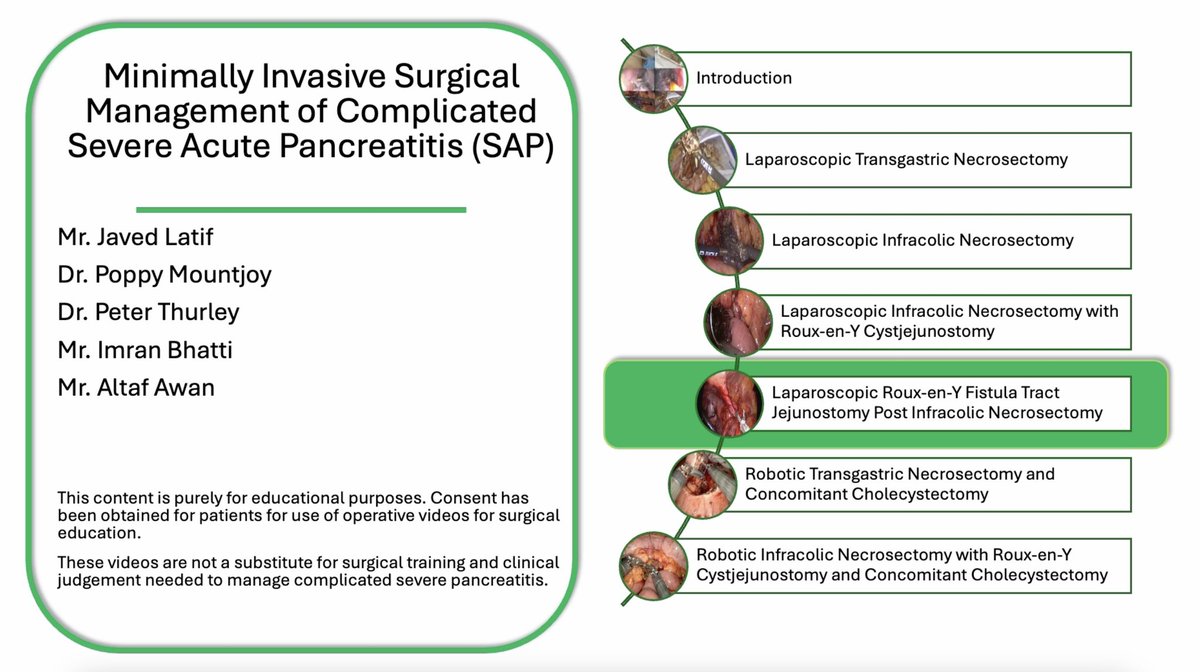 Derby Pancreaticobiliary & Robotic AWR Unit (@derbypbunit) on Twitter photo Excited to see episode 5 of our Severe Acute Pancreatitis series with <a href="/BehindTheKnife/">BehindTheKnife</a> out to view. This episode focused on Laparoscopic Fistula Tract Jejunostomy. See below!
As always thanks to <a href="/georgoff/">Patrick Georgoff, MD</a> and the BTK team for their excellent work. Excited to see episode 5 of our Severe Acute Pancreatitis series with <a href="/BehindTheKnife/">BehindTheKnife</a> out to view. This episode focused on Laparoscopic Fistula Tract Jejunostomy. See below!
As always thanks to <a href="/georgoff/">Patrick Georgoff, MD</a> and the BTK team for their excellent work.