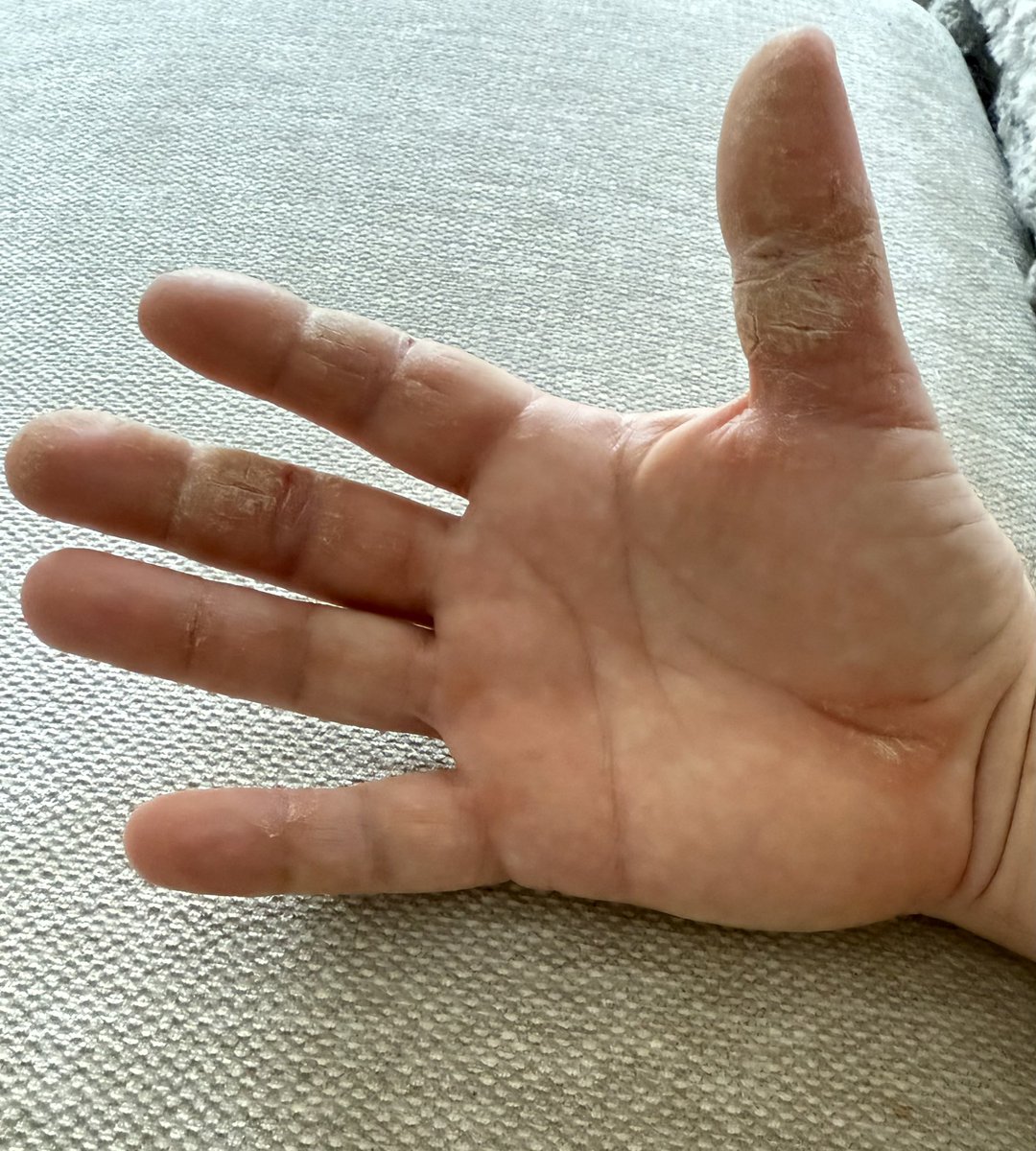 I’ve played so much tennis this month I’ve worn my hand out. I tried wearing plasters but I think they made it worse. This is my struggle.