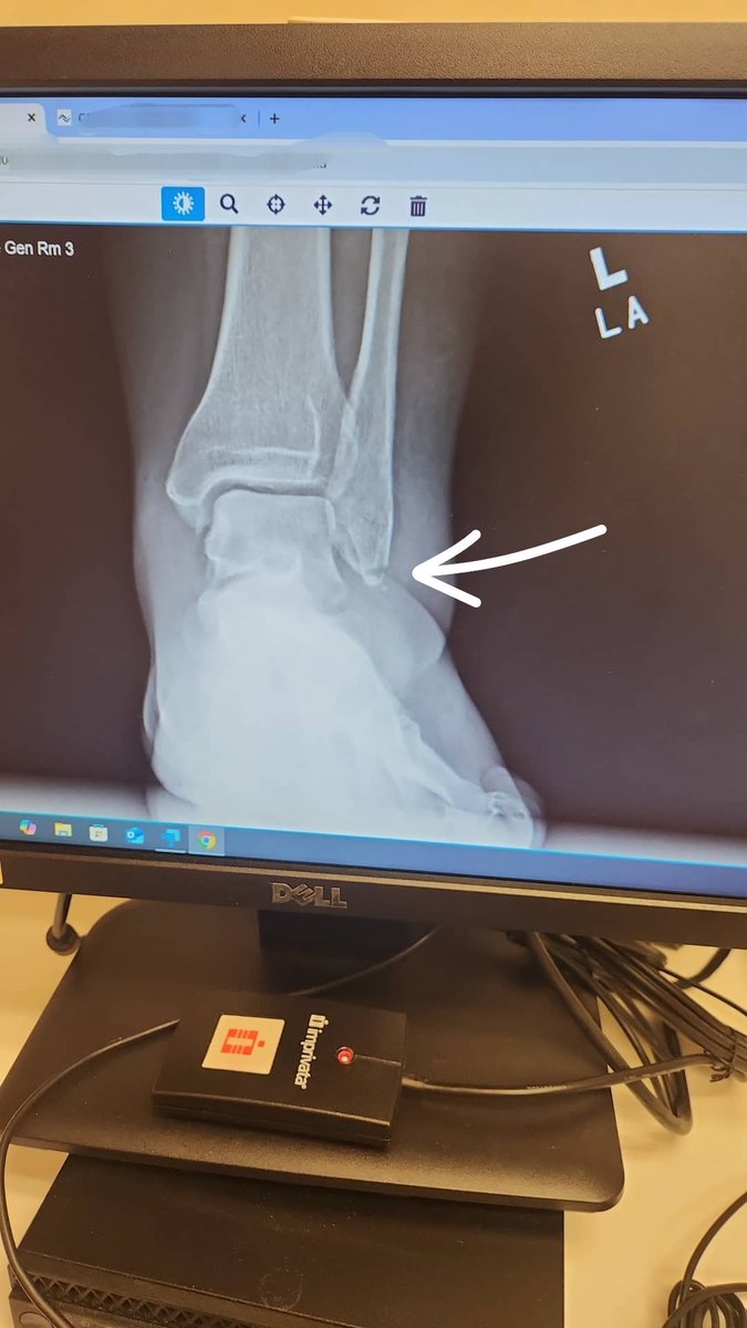 I graduated college and broke my ankle the very next day, isn't it ironic?