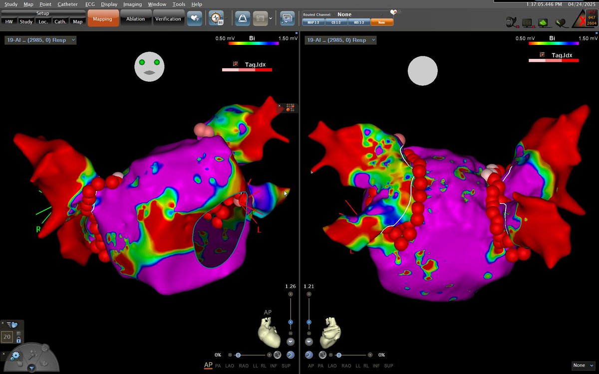 Real paroxysmal AF. #ePeeps