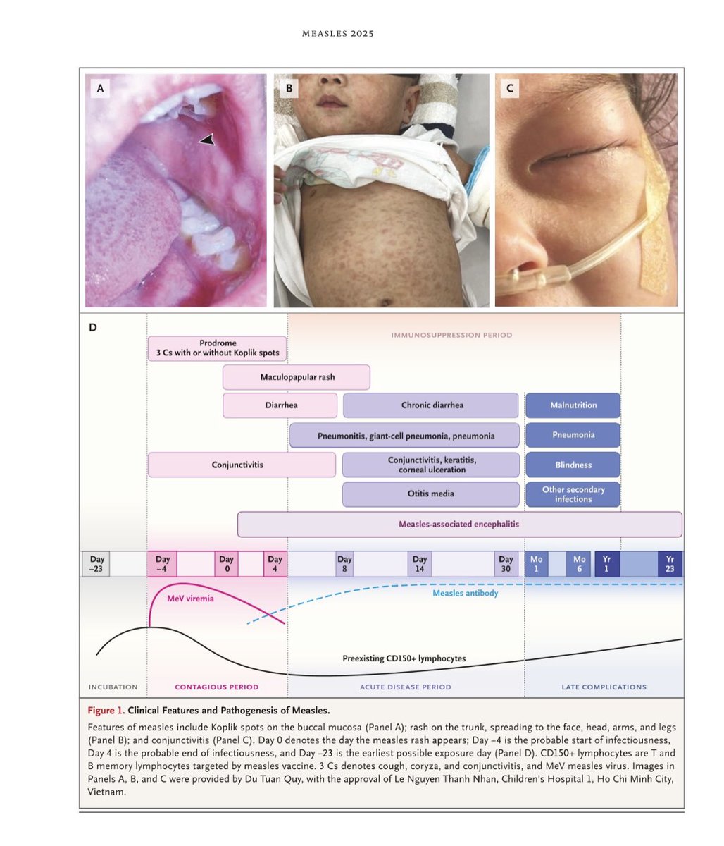 Es increíble que haya publicado un “review” en <a href="/NEJM/">NEJM</a> en 2025 de enfermedades otrora prácticamente erradicadas, que pueden causar, entre otras cosas, encefalitis graves en niños. Por la “libertad” de no vacunar