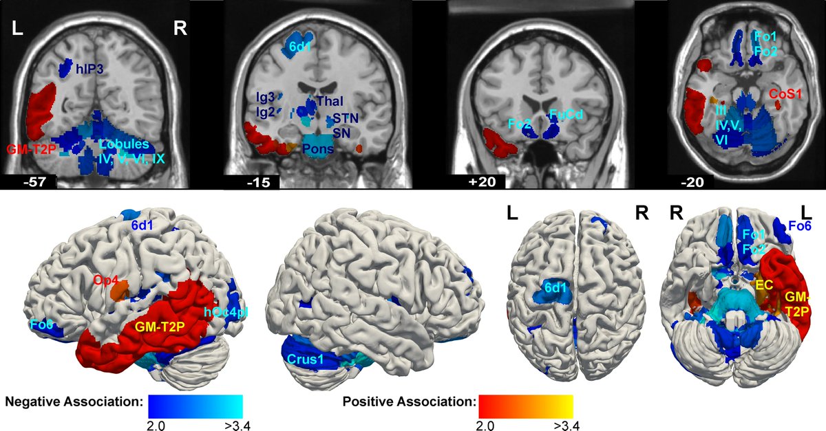 EBRAINS_eu's tweet image. A research team has used the Julich-Brain Atlas - which is freely available via the EBRAINS research infrastructure - to uncover neuroanatomical correlates of antisocial behaviour.
Read more: ebrains.eu/news-and-event…